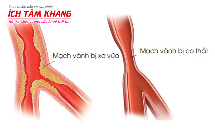 Suy vành gây ra bởi mảng xơ vữa hay tình trạng co thắt của động mạch vành